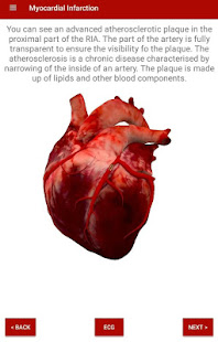 Visualization of Myocardial Infarction(圖4)-速報App