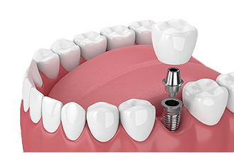 Implantes Dentários by Clínica Dentária Mint Lisboa