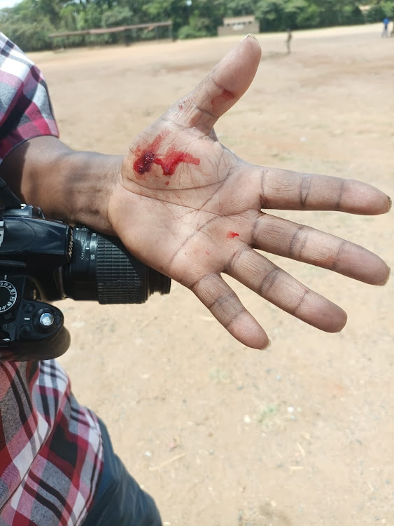 Star Journalist Musembi Nzengu injured hands while he was covering arrival of a school head in Kitui County on February 2024.
