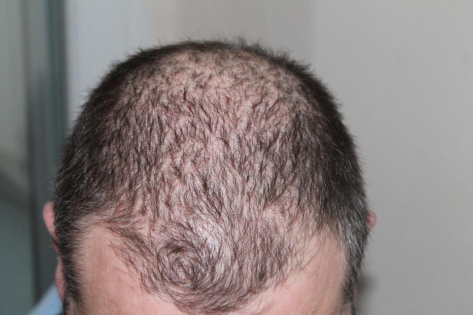 Hair, Man, Hair Loss, Head