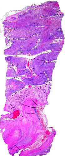 Term placenta of pacarana with subplacenta. It also shows some retroplacental clots in the decidua.