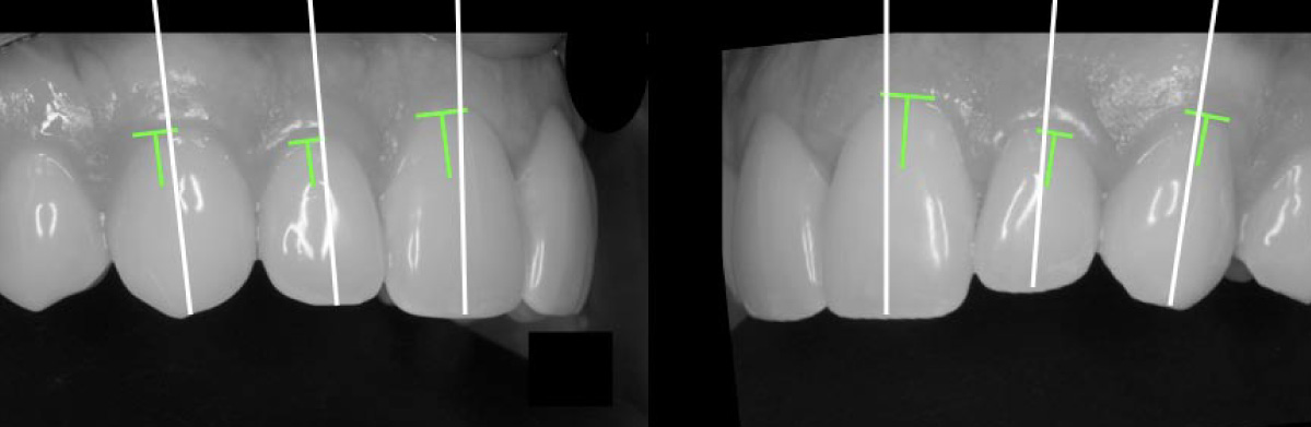 The inclination of you teeth