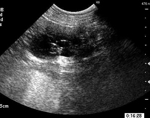 Spontaneous cystic ovary