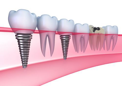 trong-rang-gia-implant-2.jpg