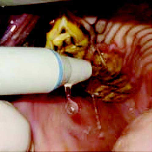 Subgingival scaling of a periodontal pocket.