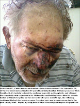 Photo: Tortured Afrikaner crime-victim Chris Bronkhorst died of maltreatment at government-hospice on April 24 2011.