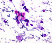 Cryptococcus, a fungus that can cause meningitis.