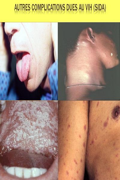   AIDS – képernyőkép 