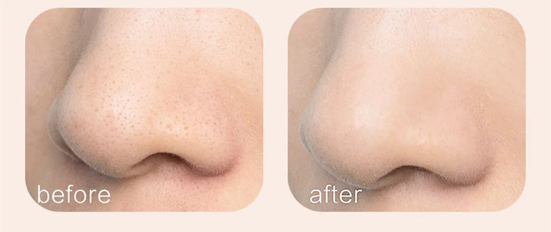 Blackhead removing instrument for clear skin. Gently exfoliates, effectively extracts, and reduces imperfections for a r