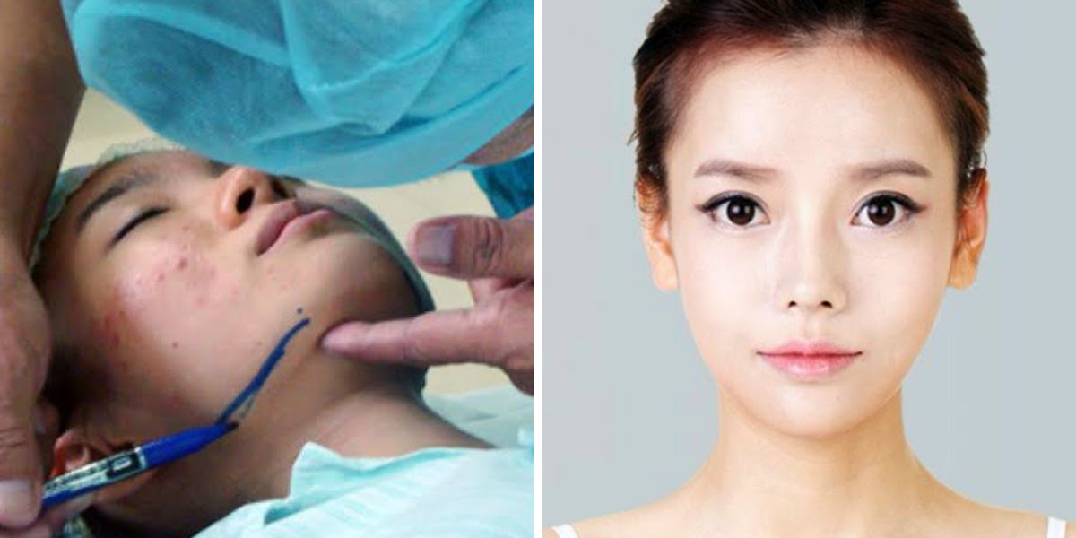 korean plastic surgery before and after jaw