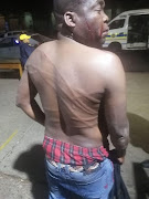 A man who identified himself as Shiba shows the welts on his back which he claims were caused by a beating by Tshwane metro cops.