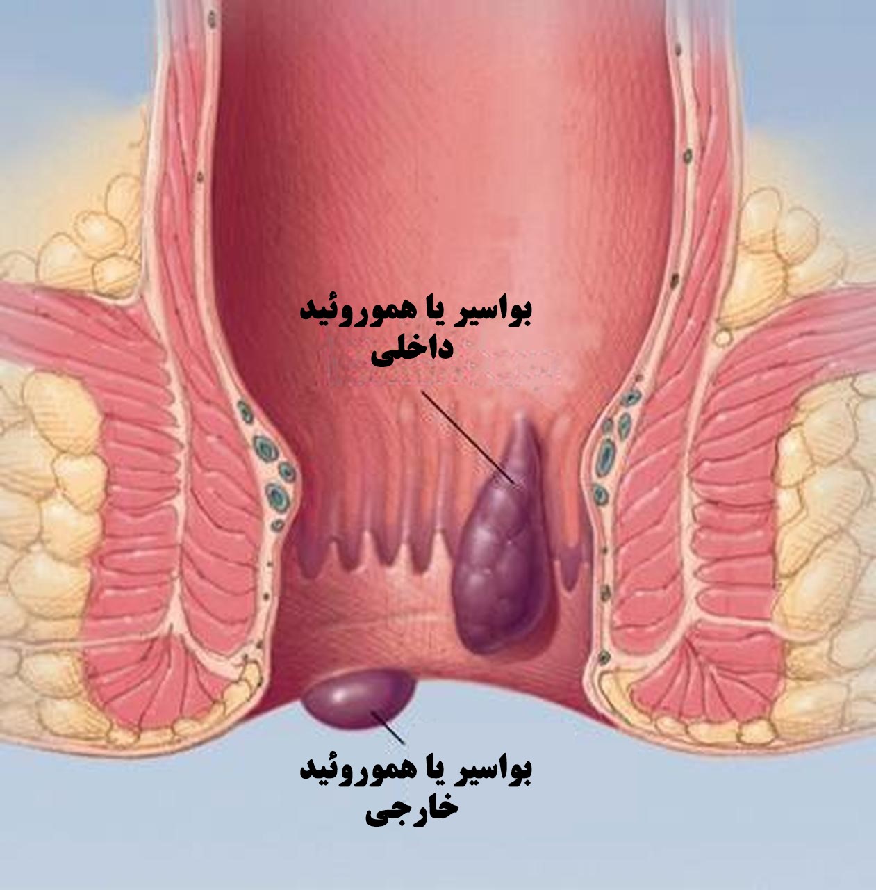 هموروئید با بواسیر خارجی چیست و بررسی بهترین روشهای درمان