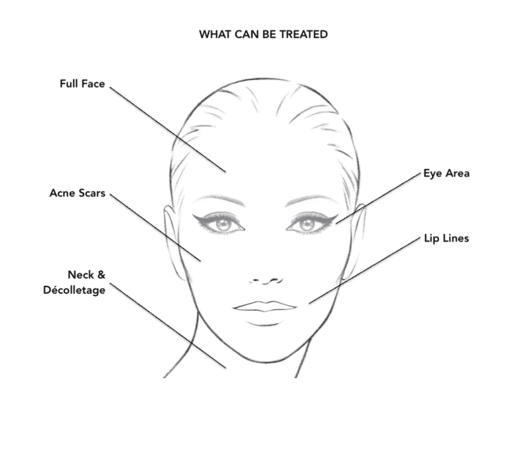 London Medical Spa - CO2 LASER RESURFACING 2/15/22. - Dr. Hal London Here  is another aggressive CO2 laser treatment of the face. This lovely patient  of mine asked me what would make