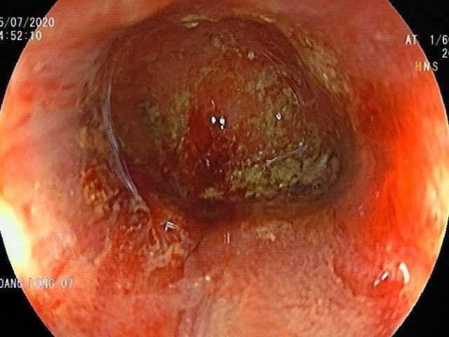 Ulcers and pus fluid in the base of the diverticulum 