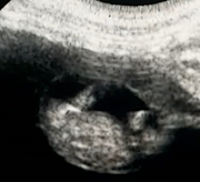 A CT scan revealed Gaia is pregnant.