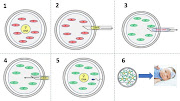 How to make a three-parent baby: 1) The egg from the mother contains the DNA (yellow circle) and faulty mitochondria (red ovals). 2) The DNA is removed from the mother’s egg using a very small pipette. 3) The DNA is removed from the mitochondrial donor egg leaving behind the healthy mitochondria (green ovals). 4) The DNA from the mother is transferred to the donor egg with the healthy mitochondria. 5) The result is an egg that has the nuclear DNA from the mother and mitochondrial DNA from the egg/mitochondria donor, which can then be fertilized with the father’s sperm. 6) As the cells replicate during embryo development, each cell will have the combined mother and father’s DNA in the nucleus of the cells and the egg donor’s mitochondria and associated mtDNA. Note: Fertilization can occur before or after transfer of DNA to the donor egg. If it happens before then both the mother and the father’s DNA will be transferred to the donor egg after the donor DNA has been removed. If it occurs after, then the egg will be fertilized after the mother’s DNA is transferred into the donor egg, as described here.