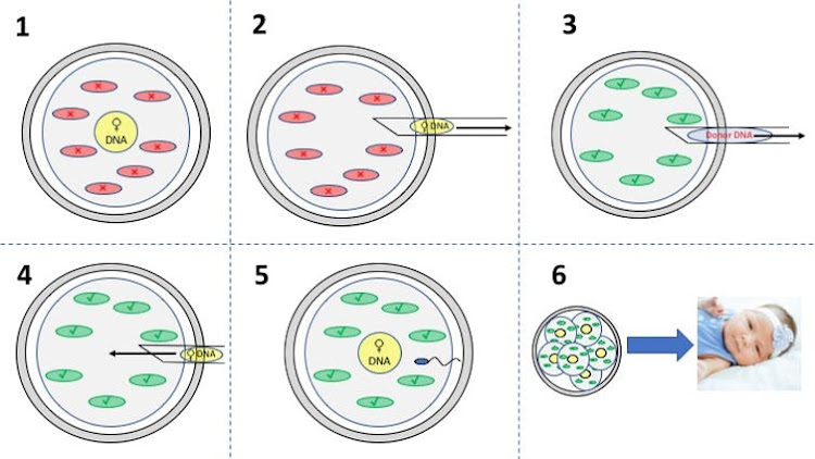 How to make a three-parent baby: 1) The egg from the mother contains the DNA (yellow circle) and faulty mitochondria (red ovals). 2) The DNA is removed from the mother’s egg using a very small pipette. 3) The DNA is removed from the mitochondrial donor egg leaving behind the healthy mitochondria (green ovals). 4) The DNA from the mother is transferred to the donor egg with the healthy mitochondria. 5) The result is an egg that has the nuclear DNA from the mother and mitochondrial DNA from the egg/mitochondria donor, which can then be fertilized with the father’s sperm. 6) As the cells replicate during embryo development, each cell will have the combined mother and father’s DNA in the nucleus of the cells and the egg donor’s mitochondria and associated mtDNA. Note: Fertilization can occur before or after transfer of DNA to the donor egg. If it happens before then both the mother and the father’s DNA will be transferred to the donor egg after the donor DNA has been removed. If it occurs after, then the egg will be fertilized after the mother’s DNA is transferred into the donor egg, as described here.