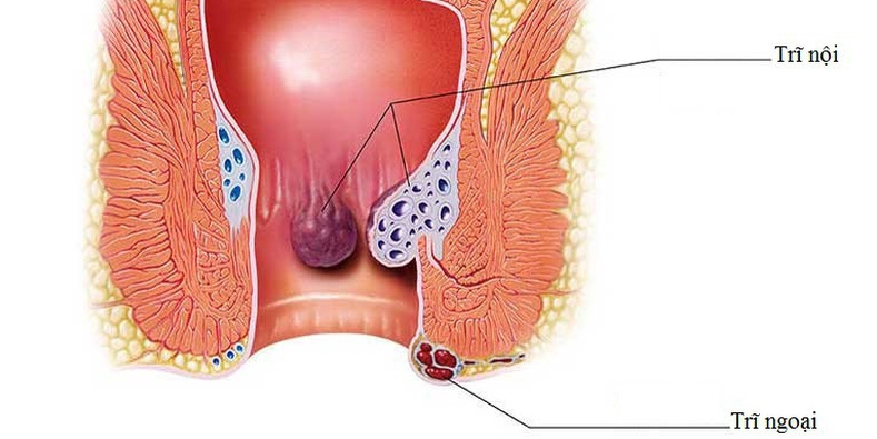 dược phẩm trị trĩ