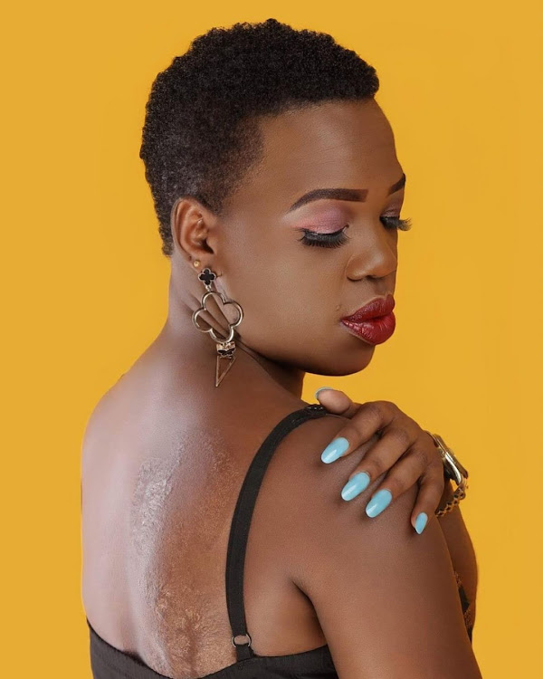 The gospel singer has revealed the source of her scars