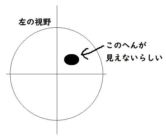 視野検査で見えなかった場所の説明図