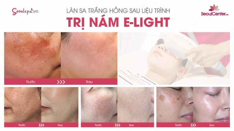           Trị nám dứt điểm bằng công nghệ Elight