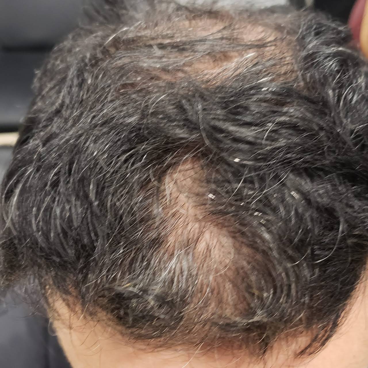 Scalpatech Scalp Micropigmentation We Offers The Most Natural