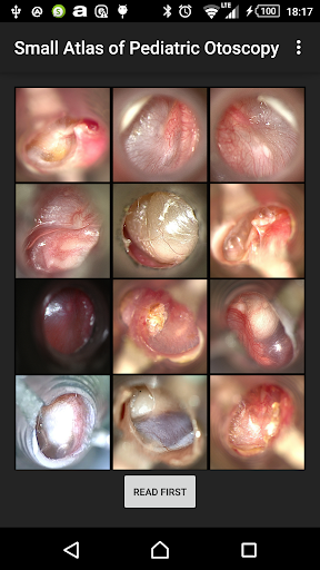 Small Atlas of Otoscopy