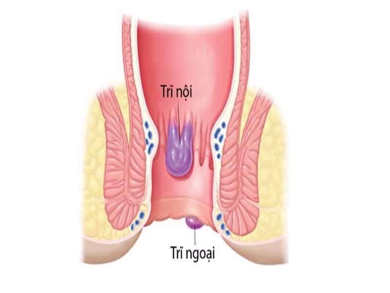 hình ảnh bệnh trĩ