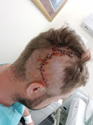 Durban businessman Ryan Moore suffered a fractured skull outside a nightclub.