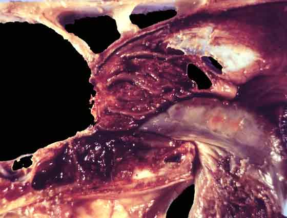 Ethmoid hematoma. The lesion is associated with multifocal areas of granulation tissue, hemosiderosis and fibrosis, and repeated episodes of hemorrhage.