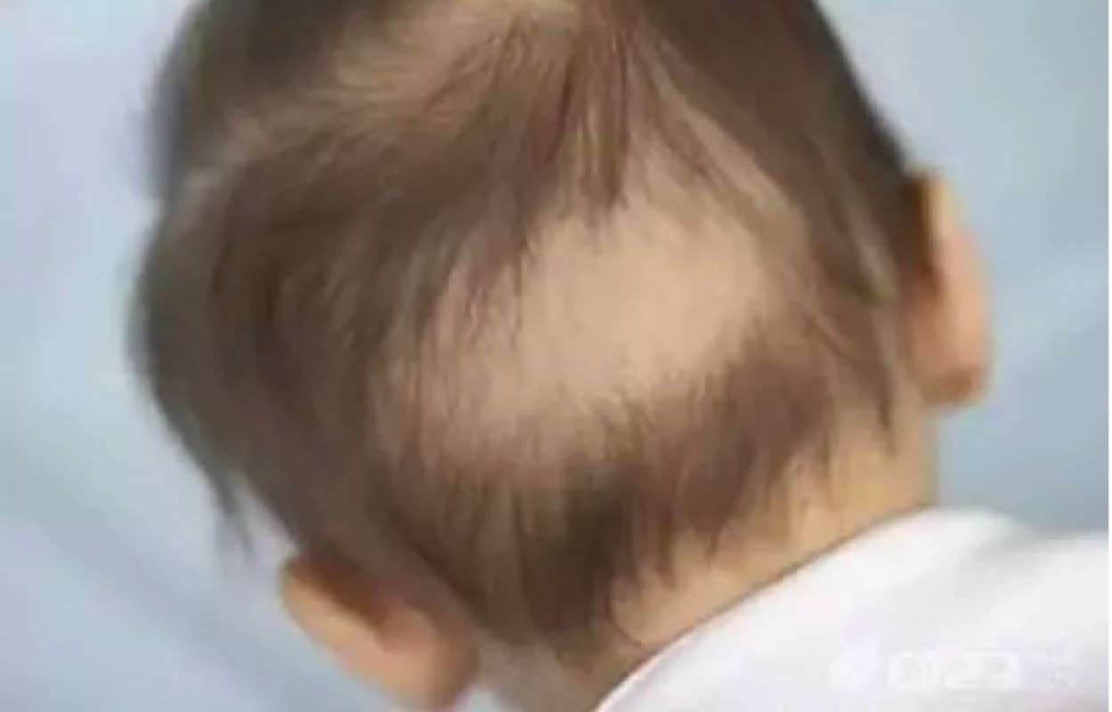 Chinese Toddler Suffers From Hair Loss After Getting Stressed Over