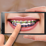 Braces on Photo. Editor Apk