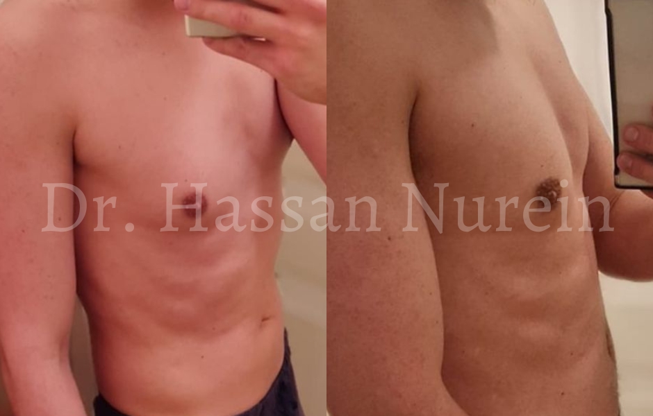 Male Chest Reduction - 001TPC-Side - The Private Clinic of Harley Street  London