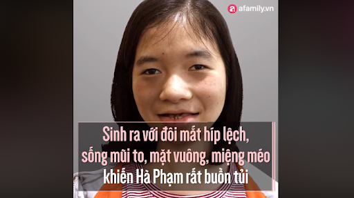 (Gương mặt trước khi phẫu thuật của Hà)