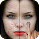 Download Pimples removing photo editing app For PC Windows and Mac 1.0