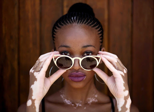 Bhisho High School's Emihle Klaas hopes to inspire people to love themselves, with all their flaws. The young model with vitiligo also hopes to follow in the footsteps of Winnie Harlow, who also has the same skin condition Picture: MARK ANDREWS