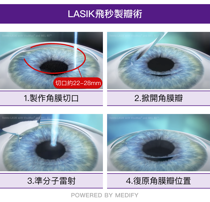 LASIK飛秒製瓣術