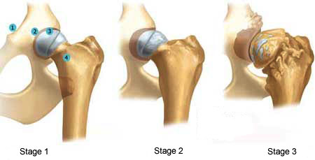 Hip dysplasia