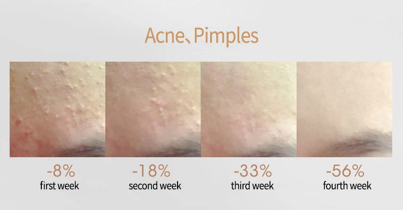 Title 8, Acne verwijderen met salicylaatproducten. Reini...