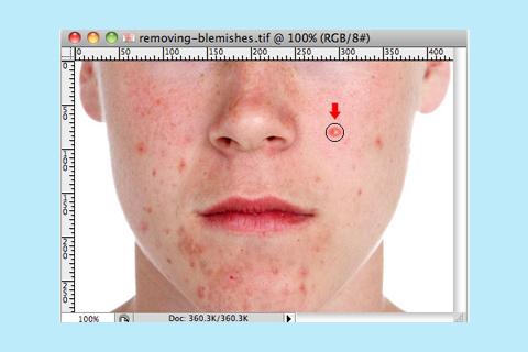 Face Blemishes Removal