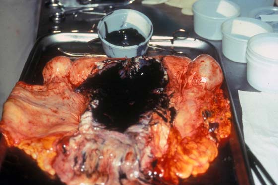 Endometrium of a mare exhibiting a delay in uterine clearance and lymphatic lacunae. Photograph taken 24 hours after intrauterine infusion of 40 ml of India ink. Cervix is located at bottom of slide. Note the black fluid in the uterine lumen and in the container at the top of the slide. Approximately 300 ml of a black tarry substance was collected from the uterine lumen.