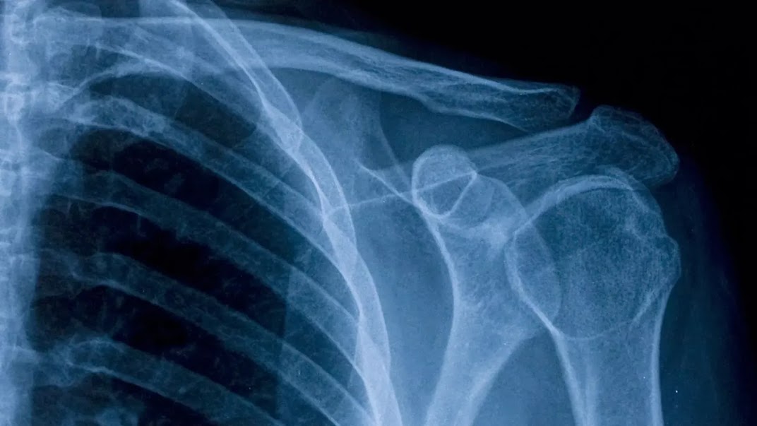 A zoomed-in X-ray image of the bones at, and near, a shoulder joint. Ribs, the shoulder, and the top of the arm are all visible.