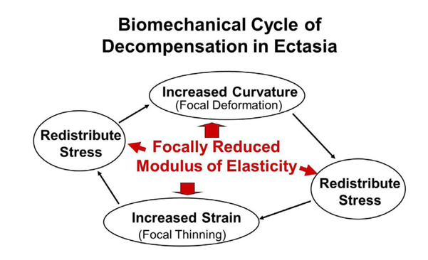 biomechanical_cycle_of_decompensation_in_Ectasia.png