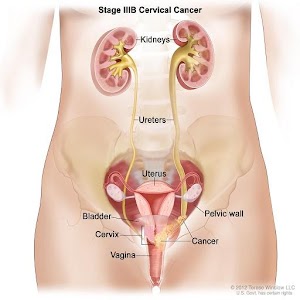 Download Cervical Cancer For PC Windows and Mac