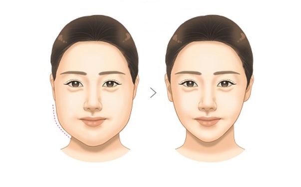 Để khuôn mặt trở nên thon gọn hơn, không ít chị em đã tìm đến với phương pháp hút mỡ mặt.