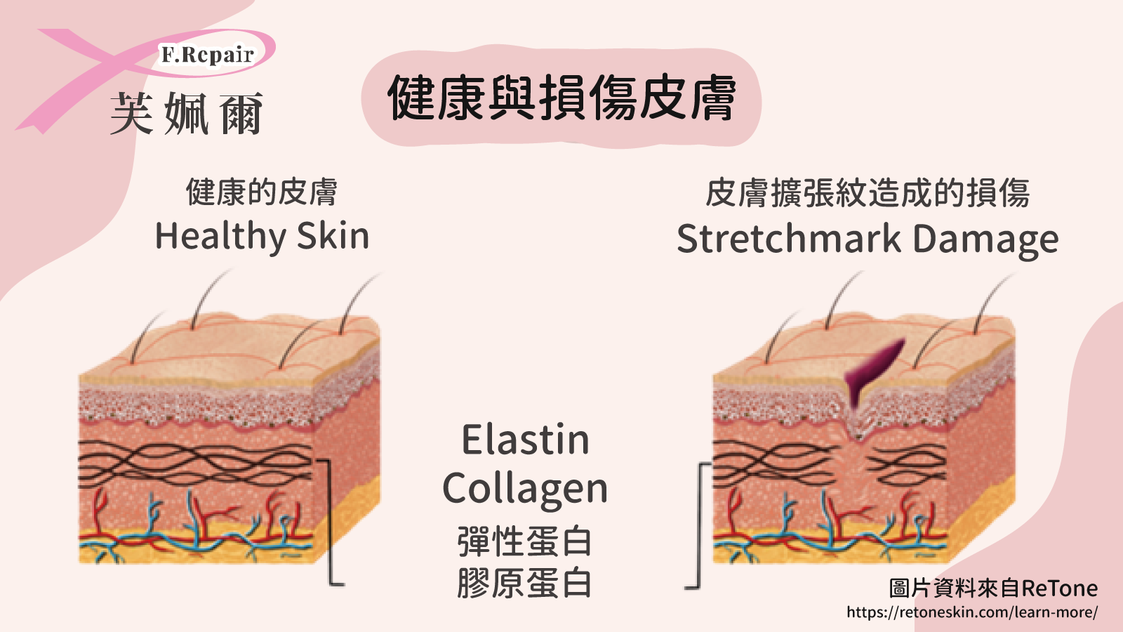 健康的皮膚,皮膚損傷,彈性蛋白,膠原蛋白,Healthy Skin,Stretchmark Damage,Elastin,Collagen,妊娠紋修復,消除紋路,芙姵爾生醫,懶人減肥,辦公室減肥,運動,消除肥肉,養身