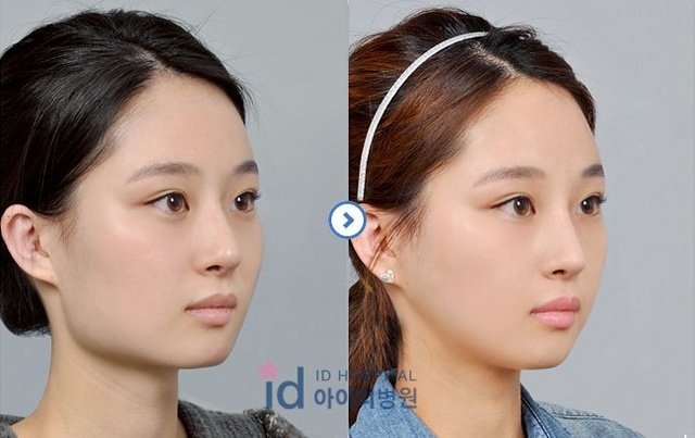 korean plastic surgery before and after jaw