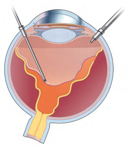 Tiny instruments are inserted into the eye in a vitrectomy. Using small incision sutureless vitrectomy technique, there is less discomfort after surgery and recovery is faster.