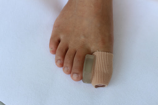 Title 6, Hallux valgus orthosis