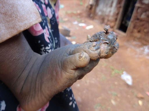 A photo of a foot infested with jiggers